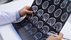 La salud de SP estudia la dispensación de cannabidiol para la esclerosis múltiple; la cartera no confirma plazo